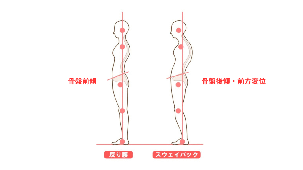 反り腰とスウェイバック